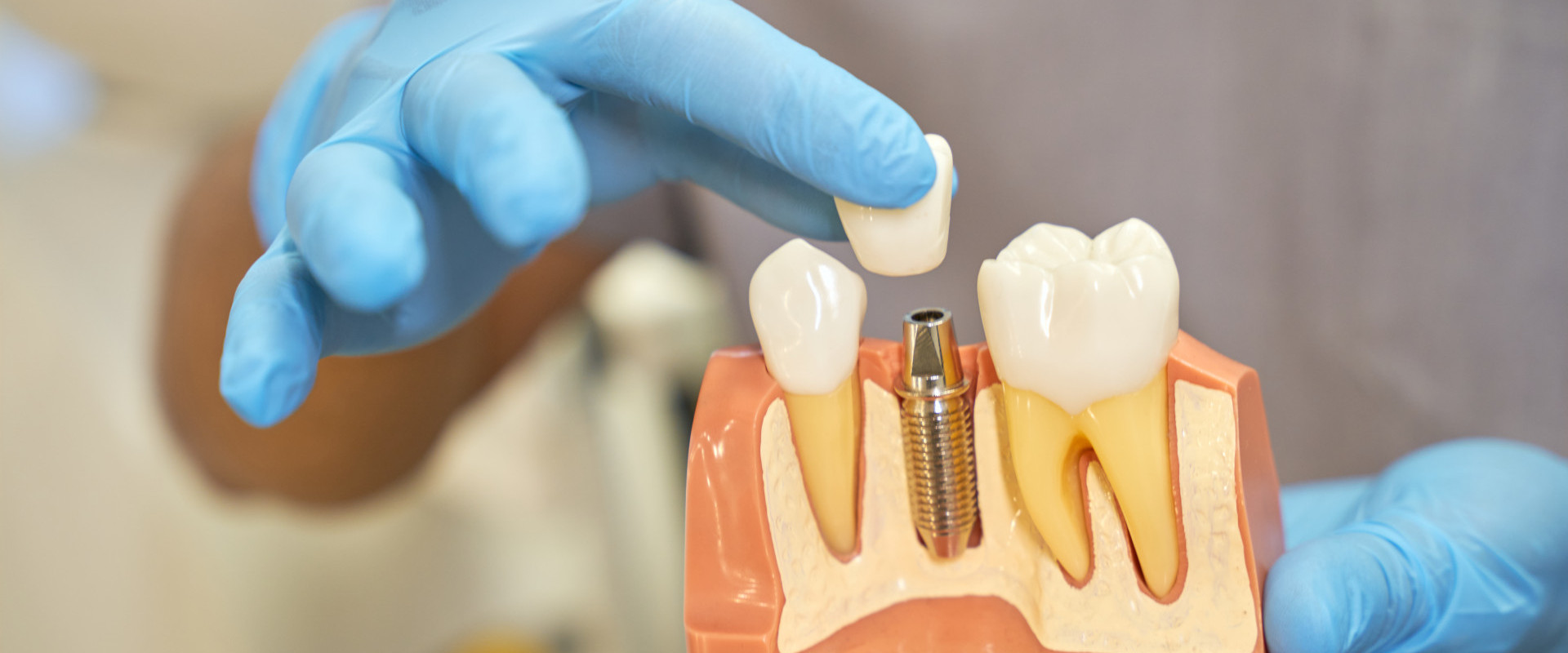 Modell von einem Zahnimplantat